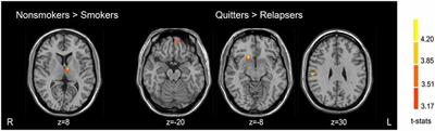 Brain Gray Matter Volume and Functional Connectivity Are Associated With Smoking Cessation Outcomes